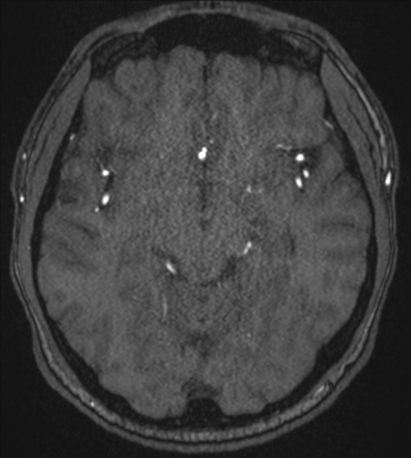 Acute left middle cerebral artery territory infarct with clot retrieval (Radiopaedia 47732-52433 Axial MRA 27).png
