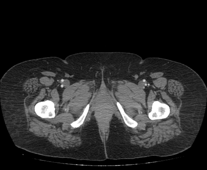 Acute mesenteric ischemia (Radiopaedia 80029-93316 Axial C+ arterial phase 145).jpg