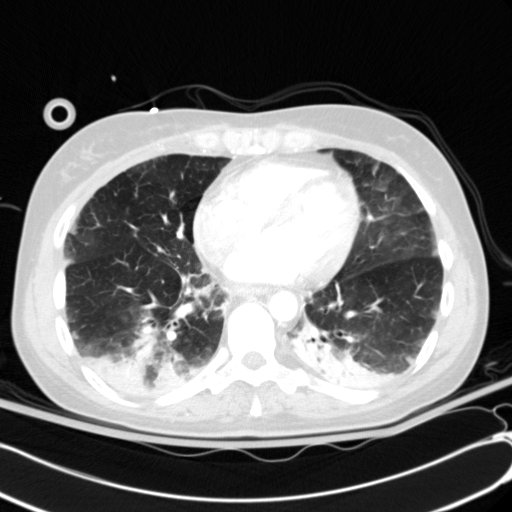 Acute myocardial infarction in CT (Radiopaedia 39947-42415 Axial lung window 86).jpg