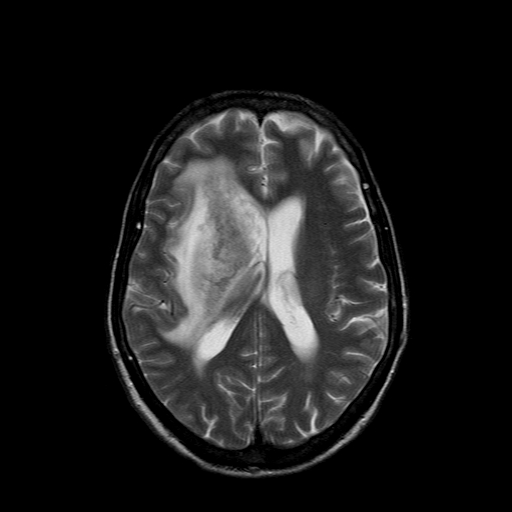 File:Acute necrotizing toxoplasma encephalitis (Radiopaedia 10683-11149 Axial T2 7).jpg