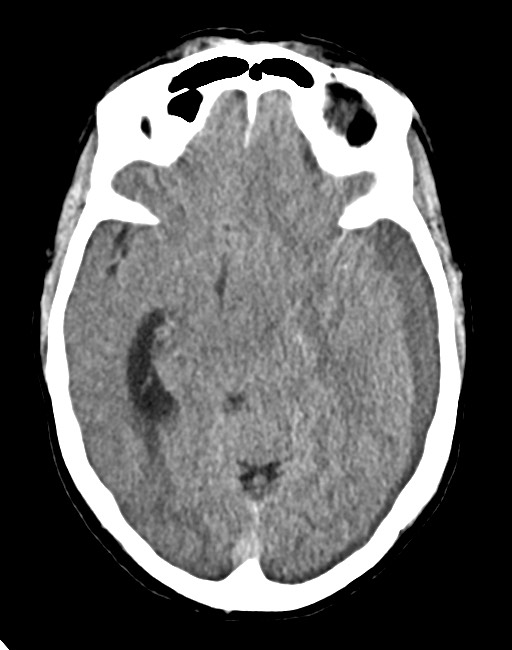 Acute on chronic subdural hematoma (Radiopaedia 74814-85823 Axial non-contrast 41).jpg