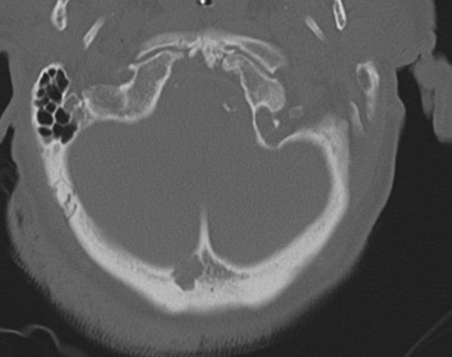 Acute on chronic subdural hematoma and thoracic vertebral injury in a multitrauma patient (Radiopaedia 31698-32619 Axial bone window 10).jpg
