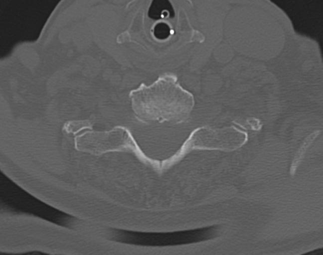 Acute on chronic subdural hematoma and thoracic vertebral injury in a multitrauma patient (Radiopaedia 31698-32619 Axial bone window 48).jpg