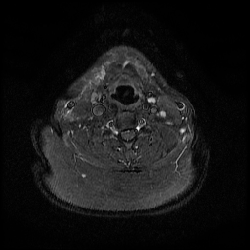 File:Acute otitis externa (Radiopaedia 57296-64236 Axial STIR 24).jpg