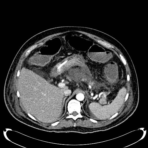 Acute pancreatic necrosis (Radiopaedia 13560-18500 Axial C+ portal venous phase 44).jpg