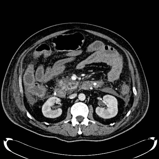 Acute pancreatic necrosis (Radiopaedia 13560-18500 Axial C+ portal venous phase 71).jpg