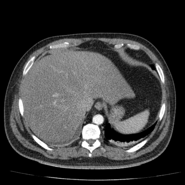 Acute pancreatitis (Radiopaedia 26663-26813 Axial C+ arterial phase 19).jpg