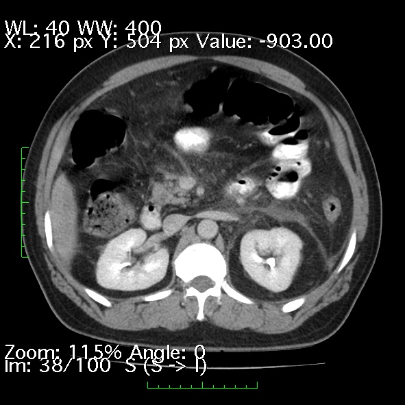 Acute pancreatitis (Radiopaedia 34043-35276 Axial C+ portal venous phase 38).jpg