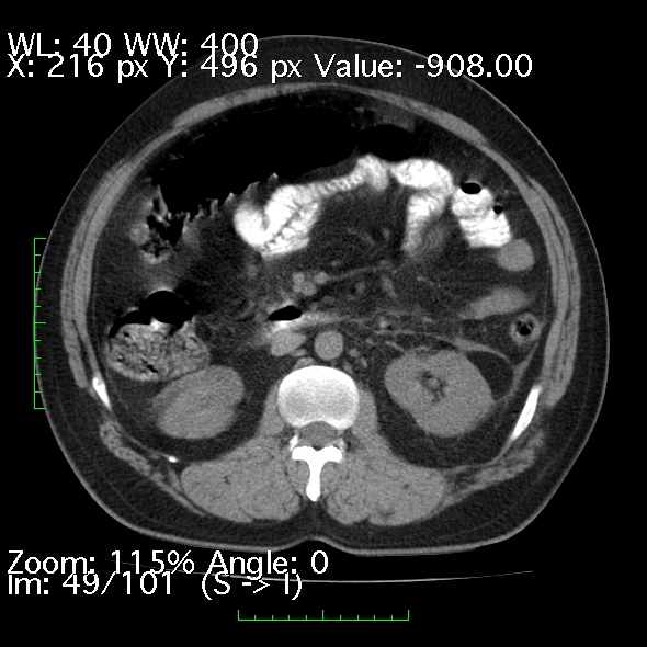 Acute pancreatitis (Radiopaedia 34043-35276 Axial non-contrast 49).jpg