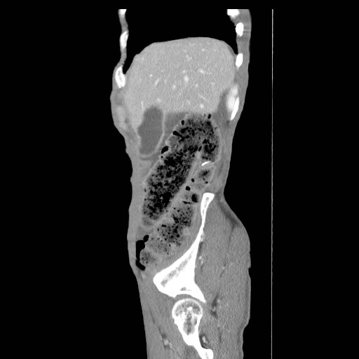 File:Acute pancreatitis (Radiopaedia 50213-55558 Sagittal C+ portal venous phase 3).jpg