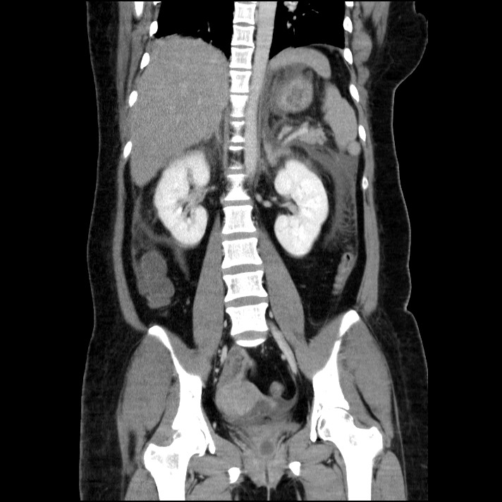Acute pancreatitis (Radiopaedia 69236-79012 Coronal C+ portal venous phase 34).jpg