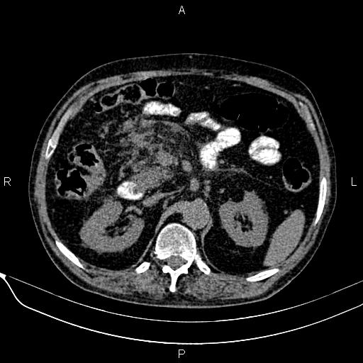 File:Acute pancreatitis (Radiopaedia 85146-100701 Axial non-contrast 47).jpg