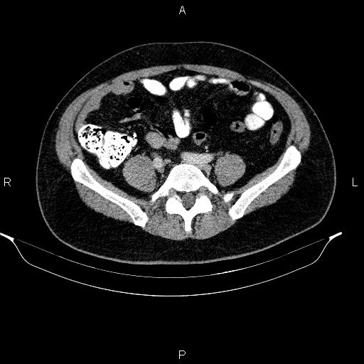 Acute pancreatitis (Radiopaedia 85390-101010 Axial C+ portal venous phase 76).jpg