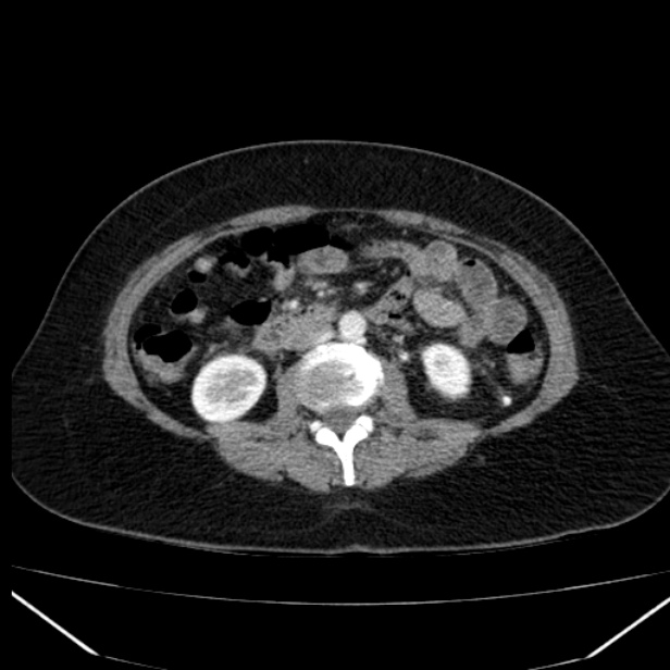 Acute pancreatitis - Balthazar C (Radiopaedia 26569-26714 Axial C+ arterial phase 46).jpg
