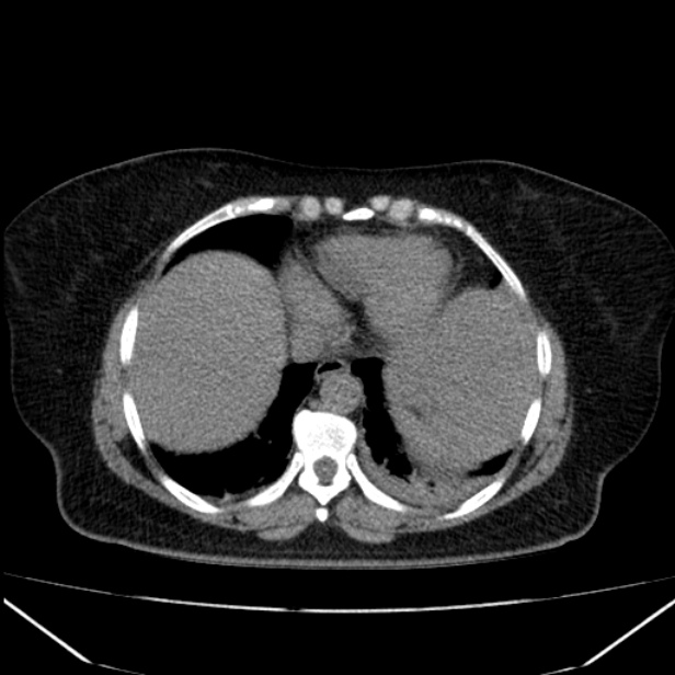 Acute pancreatitis - Balthazar C (Radiopaedia 26569-26714 Axial non-contrast 14).jpg