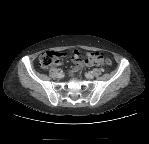 File:Acute pancreatitis - Balthazar E - post ERCP (Radiopaedia 27562-27772 Axial C+ portal venous phase 57).png