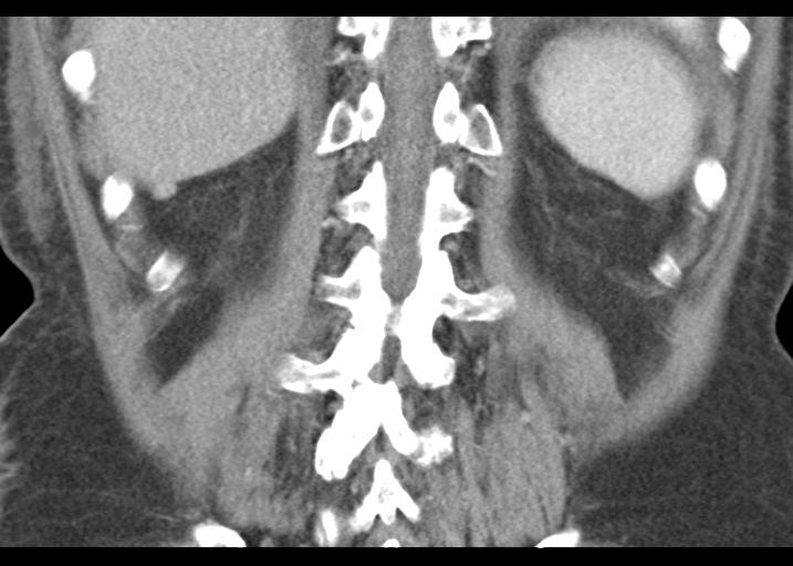 File:Acute pancreatitis and walled-off necrosis (Radiopaedia 29888-30403 Coronal C+ portal venous phase 46).jpg