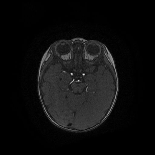 Acute phase of hemiconvulsion-hemiplegia epilepsy syndrome (Radiopaedia 29309-29745 Axial TOF angiography 85).jpg