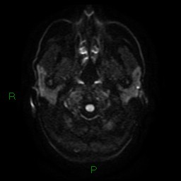 File:Acute posterior cerebral artery territory infarct (Radiopaedia 79329-92394 Axial DWI 3).jpg