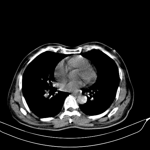 File:Acute pulmonary embolism (Radiopaedia 69510-79390 Axial non-contrast 27).jpg