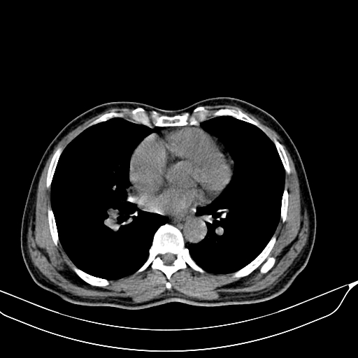 File:Acute pulmonary embolism (Radiopaedia 69510-79390 Axial non-contrast 36).jpg