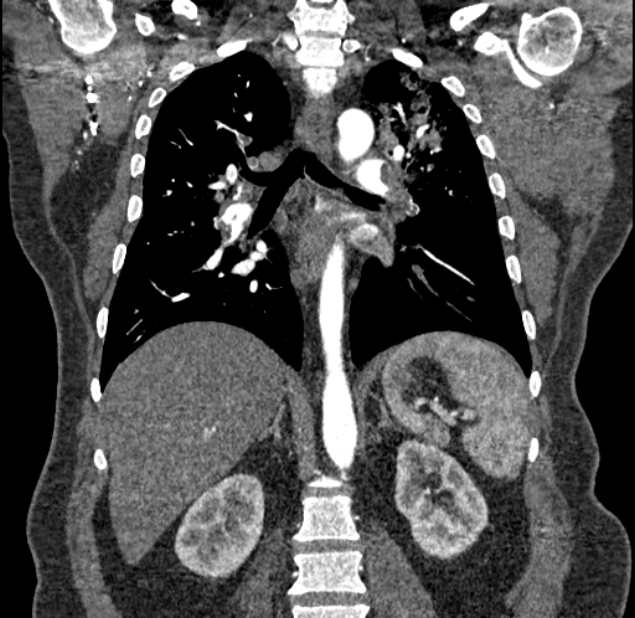 Acute pulmonary embolism with pulmonary infarcts (Radiopaedia 77688-89908 Coronal C+ CTPA 60).jpg