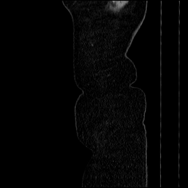 Acute pyelonephritis (Radiopaedia 33397-34434 Sagittal renal parenchymal phase 4).jpg