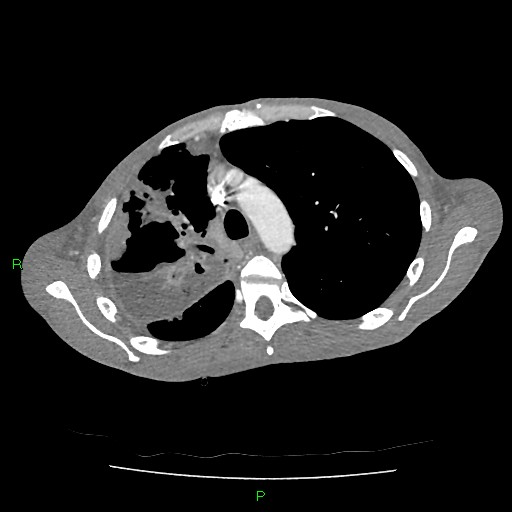 File:Acute right lung abscess (Radiopaedia 34806-36258 Axial C+ arterial phase 54).jpg