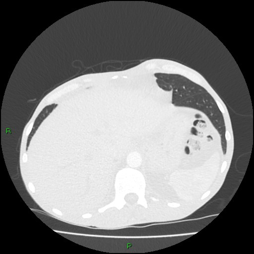 Acute right lung abscess (Radiopaedia 34806-36258 Axial lung window 168).jpg