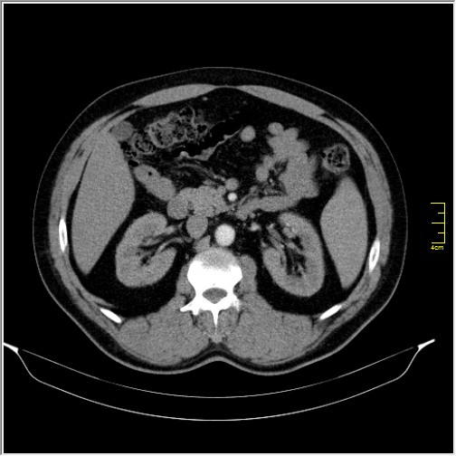 Acute right sided diverticulitis (Radiopaedia 65249-74268 Axial C+ portal venous phase 29).JPG