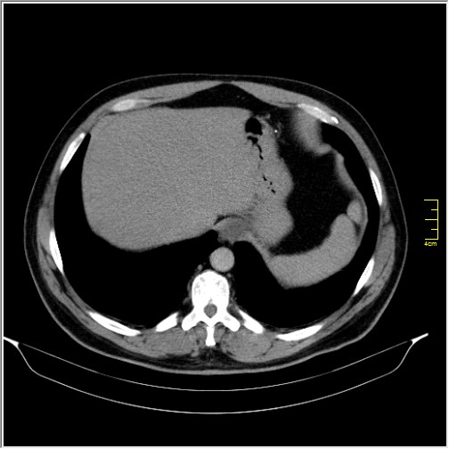 Acute right sided diverticulitis (Radiopaedia 65249-74268 Axial C+ portal venous phase 9).JPG