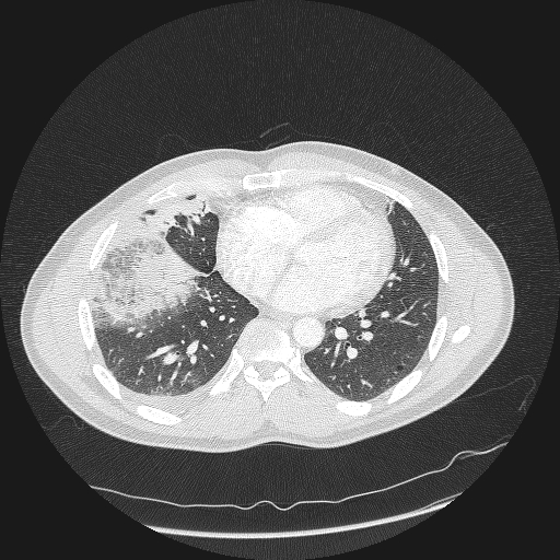 Acute segmental pulmonary emboli and pulmonary infarction (Radiopaedia 62264-70444 Axial lung window 124).jpg