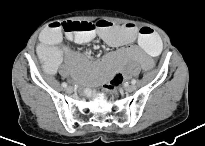 File:Acute small bowel (ileal) volvulus (Radiopaedia 71740-82139 Axial C+ portal venous phase 152).jpg