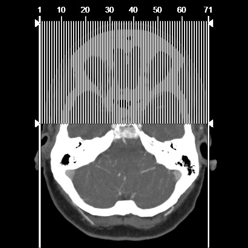 Acute subarachnoid hemorrhage and accessory anterior cerebral artery (Radiopaedia 69231-79009 Sagittal C+ arterial phase 1).jpg