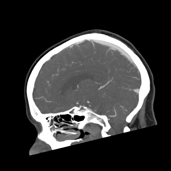Acute subarachnoid hemorrhage and accessory anterior cerebral artery (Radiopaedia 69231-79009 Sagittal C+ arterial phase 34).jpg