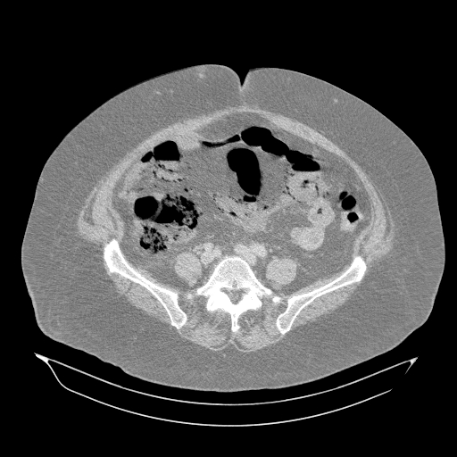 Acute superior mesenteric artery occlusion (Radiopaedia 51288-56960 Axial lung window 48).jpg