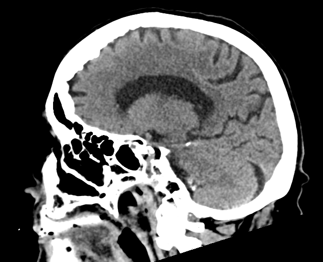 File:Acute traumatic subdural hematoma (Radiopaedia 82921-97257 Sagittal non-contrast 44).jpg