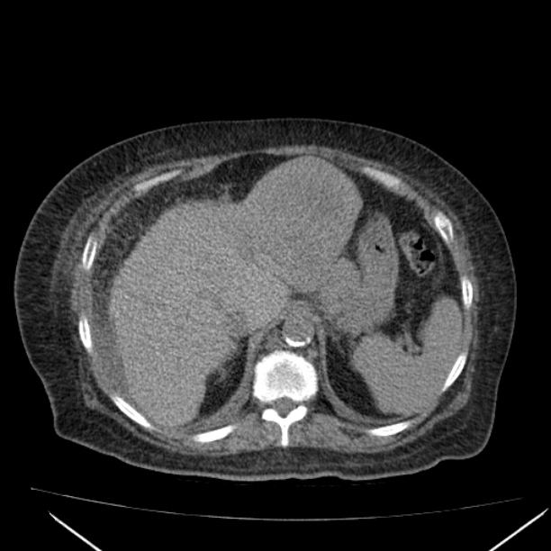 Acute tubular necrosis (Radiopaedia 28077-28334 Axial non-contrast 17).jpg
