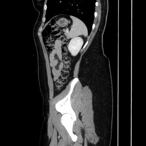 Acute uncomplicated appendicitis (Radiopaedia 73704-84499 Sagittal C+ portal venous phase 155).jpg