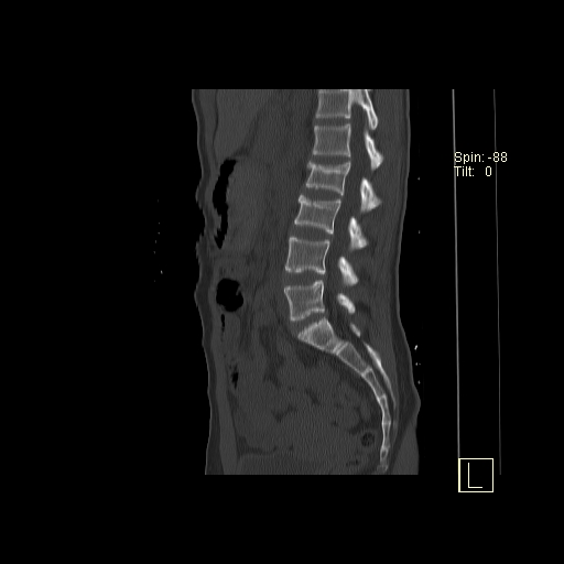 File:Acute vertebral compression fracture (Radiopaedia 63832-72559 Sagittal bone window 8).jpg