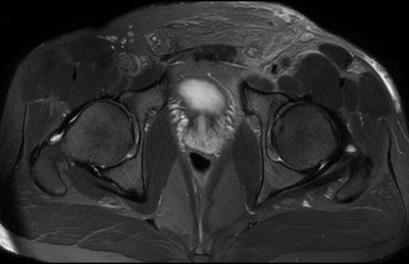 File:Adductor longus tear with retraction (Radiopaedia 56424-63103 Axial T2 fat sat 15).jpg