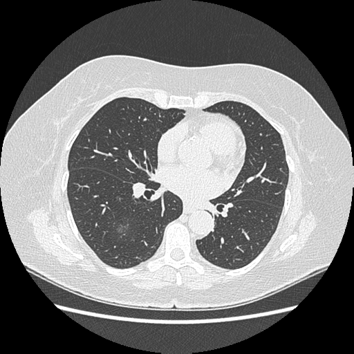 Adenocarcinoma in situ of lung (Radiopaedia 38685-40829 B 124).png
