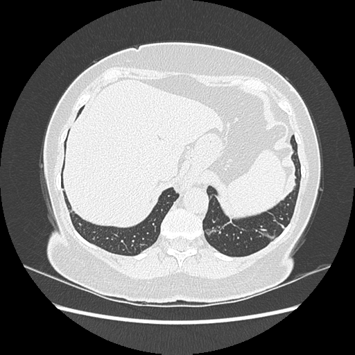 Adenocarcinoma in situ of lung (Radiopaedia 38685-40829 B 204).png