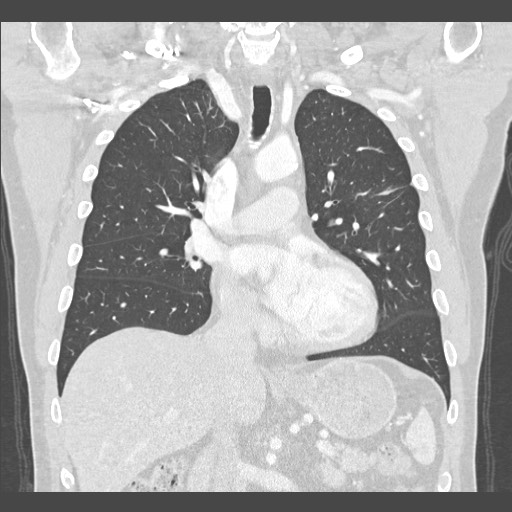 Adenocarcinoma of the lung (Radiopaedia 59871-67325 Coronal lung window 26).jpg