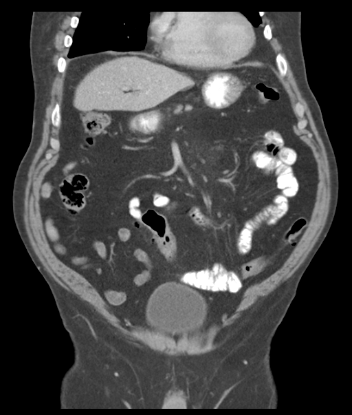 Adenocarcioma of rectum- T1 lesion (Radiopaedia 36921-38547 Coronal C+ portal venous phase 21).png