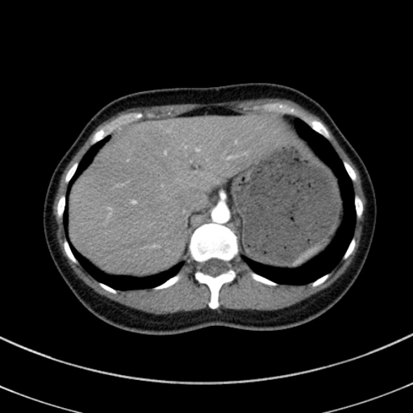 Adenocystic carcinoma of the trachea (Radiopaedia 47677-52525 Axial C+ arterial phase 75).jpg