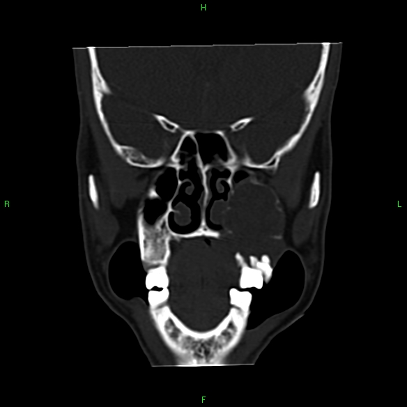 File:Adenoid cystic carcinoma of hard palate (Radiopaedia 26137-26273 Coronal bone window 11).jpg