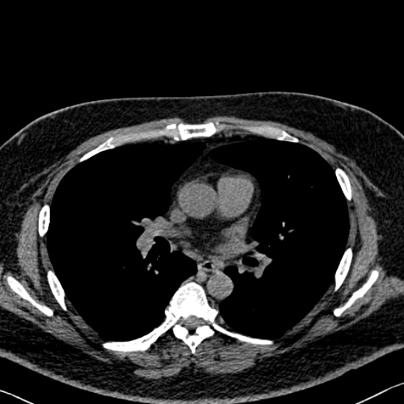 Adenoid cystic carcinoma of the trachea (Radiopaedia 49042-54137 Axial non-contrast 172).jpg