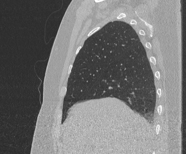 Adenoid cystic carcinoma of the trachea (Radiopaedia 49042-54137 Sagittal lung window 110).jpg