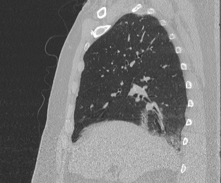 Adenoid cystic carcinoma of the trachea (Radiopaedia 49042-54137 Sagittal lung window 160).jpg